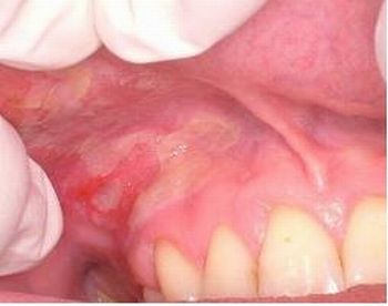 cancer boca
